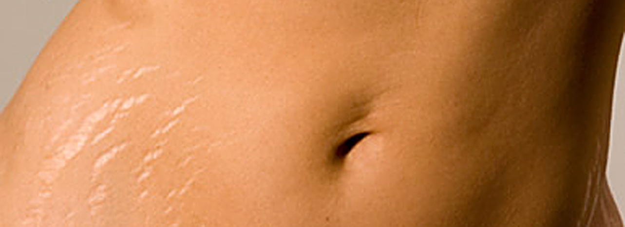 Stretch-marks-1