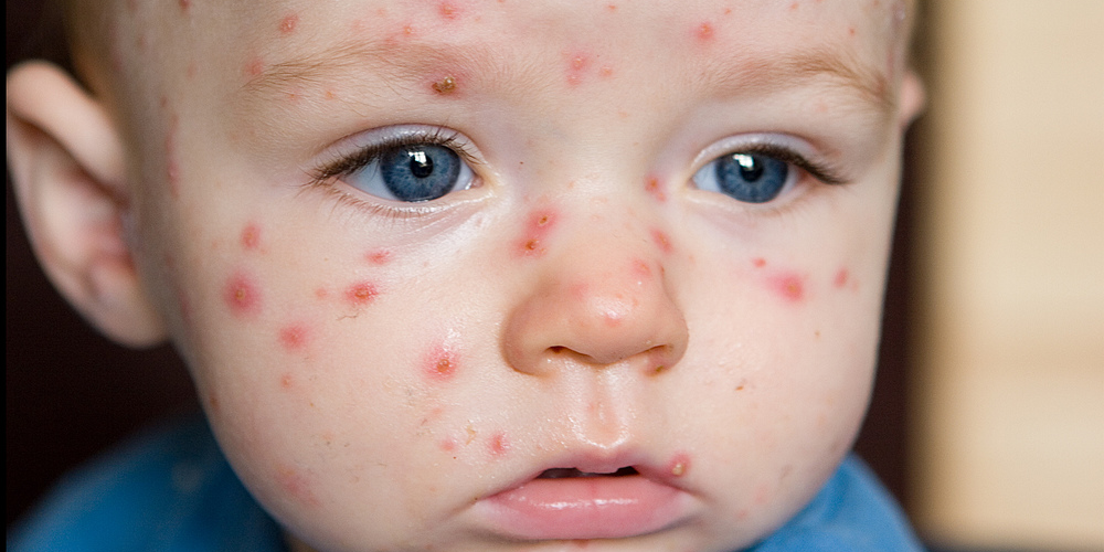 Hilangkan Bekas Chicken Pox Dengan 3 Bahan Mudah